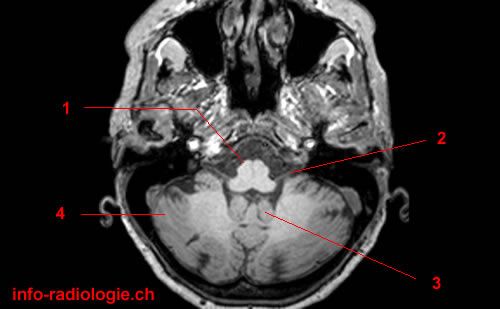 Atlas of BRAIN MRI - W-Radiology Atlas of BRAIN MRI - W-Radiology