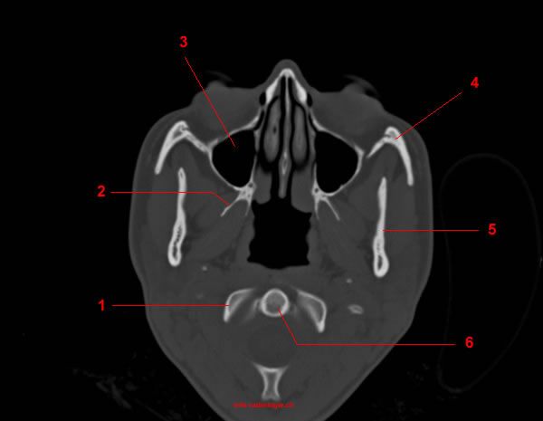 Skull CT anatomy - W-Radiology