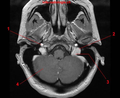 ボールガイ　mri High-b-Value Diffusion-Weighted MR Imaging of Hyperacute