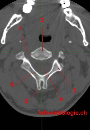 CT of the Craniocervical junction - W-Radiology