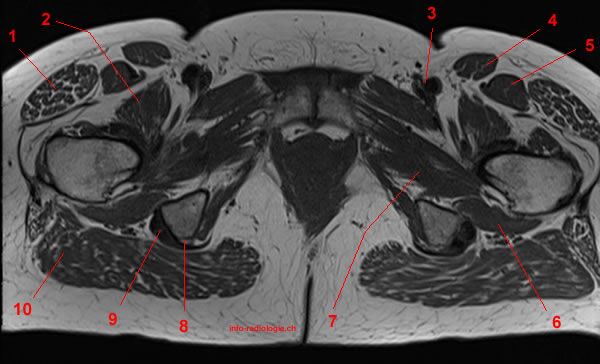 MRI of the Hip: Detailed Anatomy - W-Radiology